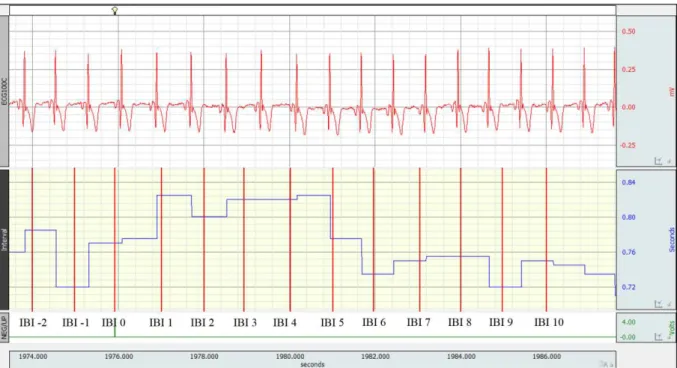Figura 8. Representação do procedimento realizado no pre-processamento dos dados de ECG,  com  destaque  para  os  diferentes  canais  (superior  relacionado  ao  registro  ECG,  e  inferior  relacionado ao intervalo de tempo entre os batimentos cardíacos)