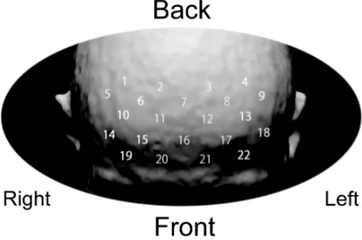 Figure 3. Correlation of change in Stanford Sleepiness Scale (SSS) level with reaction time