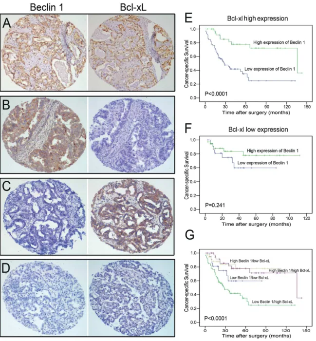 Figure 3. The expression patterns of Beclin 1and Bcl-xL in ovarian carcinoma and Kaplan-Meier survival analysis