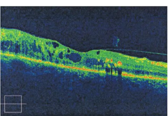 Figura 2 - Apresenta edema macular cistóide e exudados duros (Imagem gentilmente cedida  pelas Clínicas Leite) 