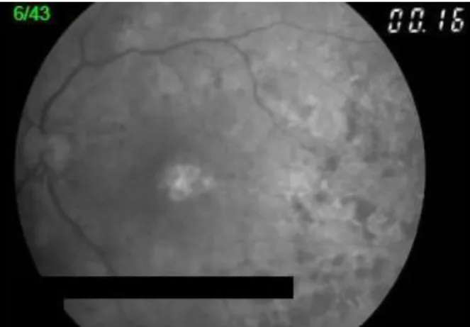 Figura 10 - O corante ainda não chegou às artérias da retina, mas já se pode observar uma  hiperfluorescência na área da mácula (Fotografia cedida gentilmete pelas Clínicas Leite) 