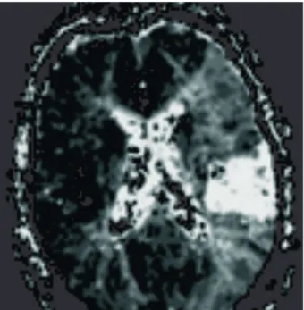 Figure 12. MRI perfusion of CVI