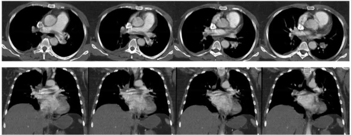 Fig. 3. Central PE in an obese patient. Normal dose CT protocol was used (axial and coronal view).