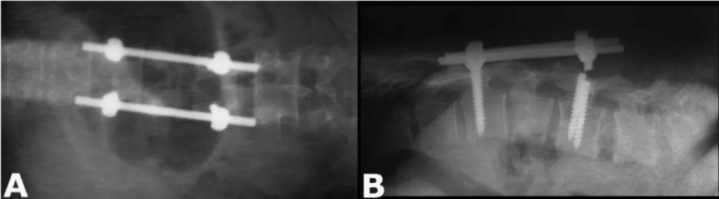 Fig. 1: X-ray dorso lumbar spine AP and lateral view showing broken hardware.