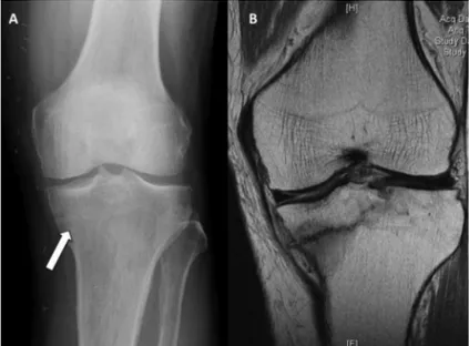 Fig. 1: (A) Weight bearing X-ray of the left knee showing lucency over medial proximal  tibia