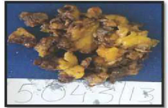 Fig. 1: Gross Specimen of Adrenal  Myelolipoma Showing Dark Brown and 