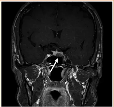 Fig. 2. A T1-weighted coronal magnetic resonance imaging of the  sella turcica indicated a 10 × 6-mm hypointense, nonenhanced  pi-tuitary adenoma on the left side of the pipi-tuitary gland (arrow).