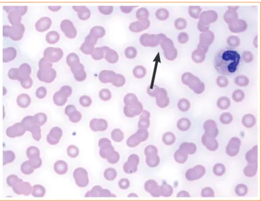 Fig. 3. Peripheral blood smear results revealed a red blood cell  rouleaux formation (arrow; Wright stain,  × 1,000).