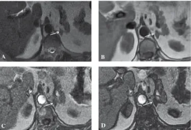 Figure 3. A follow-up magnetic resonance image examination performed  6 years later showed a well-circumscribed solid mass (2 cm x 1 cm) (arrow)  on axial T2- (A) and T1- (B) weighted magnetic resonance images