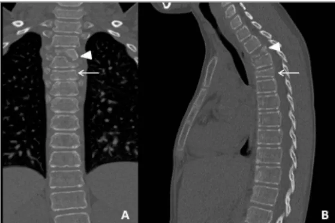 FIGURE 1. Spinal computed tomography (CT) evidenced lytic destruction of 3th and 4th, and collapse of 5th thoracic vertebral bodies, originating kyphotic deformation