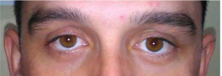 Fig. 1 – Typical ocular (facial) asymmetry in silent sinus syndrome (SSS) – hypoglobus and enophthalmos   (3 mm) on the left side; upper-lid retraction, deepened upper-lid sulcus
