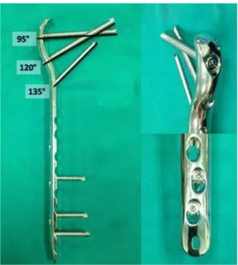 Fig.  1:  The  locking  compression  plate  for  the  proximal  femur is a precontoured, angular stable, with large  fragment screw (7.3/5.0/4.5mm).