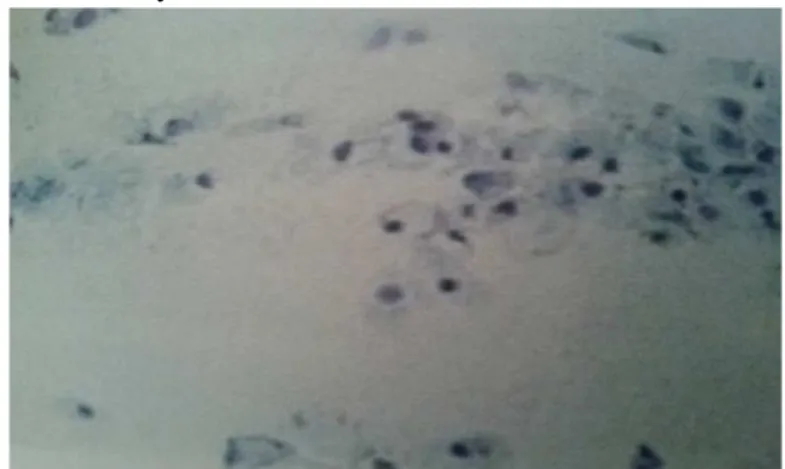 Figure 1 Horny cells (keratin) vaginal smears stained with Giemsa  