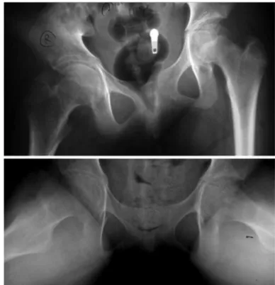 Fig. 3: (Case  3)  Radiographs  of  both  hips  reveal  diffuse narrowing  of  the  right  joint  space  with  periarticular osteopenia and subchondral bone cyst.