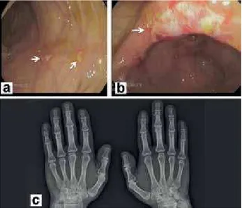 Figure  1. a,  b)  Show  supericially  localized  ulcers  in  distal  ileum  in  Crohn  disease,  c)  reveals  narrowing  in  proximal  interphalengeal joints