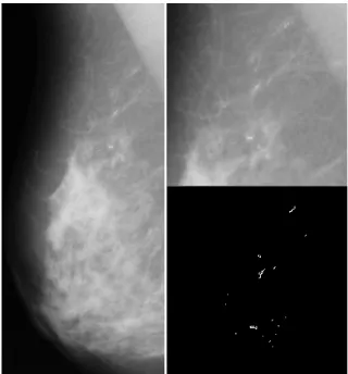 Fig. 2.  Fragment of a mammogram and extracted microcalcifications. 