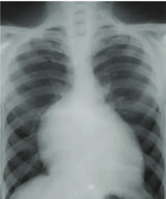 Figure 2. X-ray findings of enlarged heart silhouette