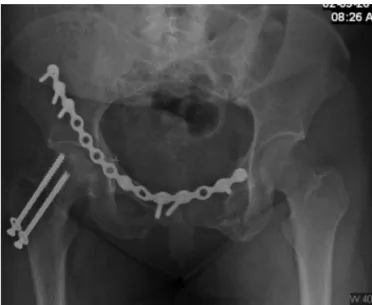 Fig. 1d: Pelvic  radiograph  following  open  reduction  and  ring internal  fixation  showing  acceptable  alignment,  screw fixation neck of femur in situ.