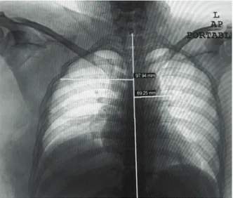 Fig. 1: Chest radiograph with ribs fractures and pneumothorax. Fig. 2: Scapulothoracic  dissociation,  scapula  fracture,  ACJ separation