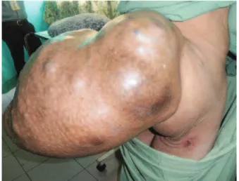 Fig. 1b: Patient  unable  to  sleep  in  supine  position  due  to  the sacral mass.