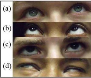 Figure  2.  Upgaze  (a  and  b)  and  eye  roll  (c  and  d)  variations  associated  with  hypnotic  capacity 