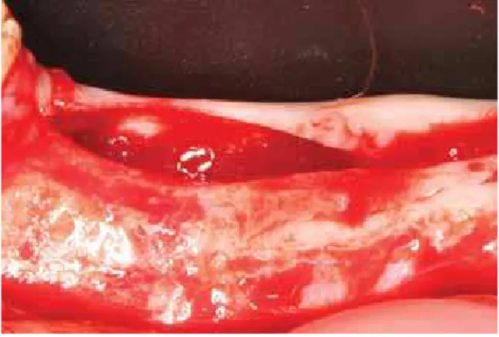 Fig. 1 The alveolar ridge completely healed after the full-thickness lap  elevation for implant placement.