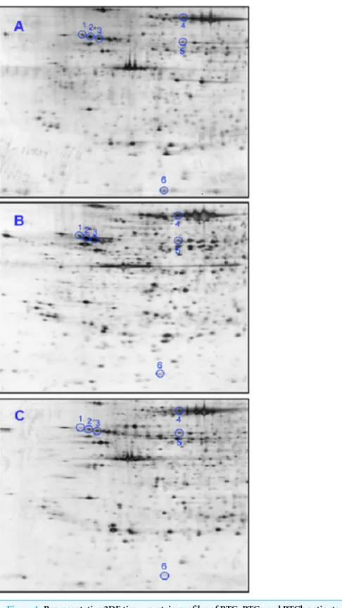 Figure 1 Representative 2DE tissue protein profiles of BTG, PTCa and PTCb patients. Tissue samples of (A) BTG (n = 20), (B) PTCa (n = 8) and (C) PTCb (n = 6) patients were subjected to 2DE and silver staining