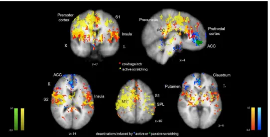 Figure  3.    A)  Brain  activations  induced  by  active  scratching  an  itch  (red)  are  displayed  together  with  the  activations induced by the passive scratching an itch (blue), analyzed as stand-alone conditions