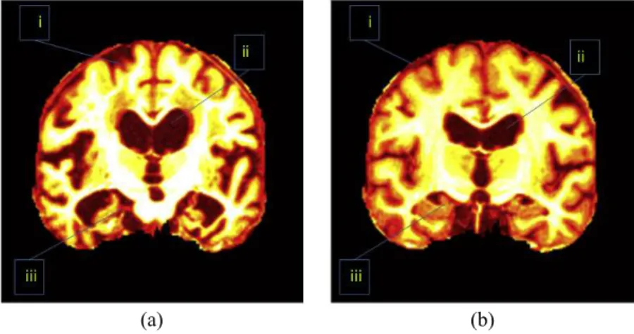 Figure 2 Important regions between (A) an AD brain and (B) a normal brain. i, CC; ii, ventricle; iii, HC