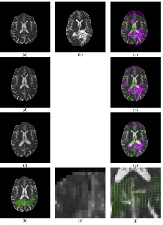 Figure 4 Illustration of displacement field between a Glioma brain and a normal one. (A) Moving Image I 1 ; (B) Reference Image I 2 ; (C) Overlap of (B) and (A); (D) Rigid Registration of I 1 ; (E) Overlap of (B) and (D); (F) Non-rigid registration of (D);