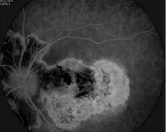 Fig. 2. Fundus fluorescein angiography of an active lesion (early and late phase): active lesion in macula