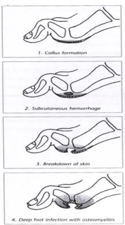 Fig. 9: Fases de formação da úlcera (Fonte: IWGDF, Holland, 1999. International Consensus on the Diabetic Foot) 
