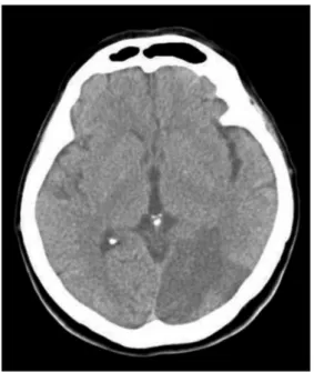 Figure 1. Ischemic stroke in temporo — occipital lobe (by computed tomography scan) in patients