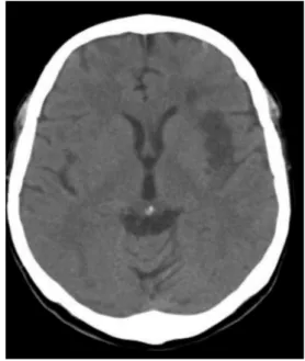 Figure 3. Ischemic stroke in fronto-temporal lobe (by computed tomography scan) in patients