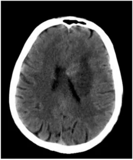 Figure 4. Ischemic stroke in parietal lobe (by computed tomography scan) in patients with transcortical motor aphasia, alexia, agraphia