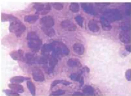 Fig. 1: Microphotograph showing Oncocytic  Cells in Cytological Smear (Giemsa, X 400)