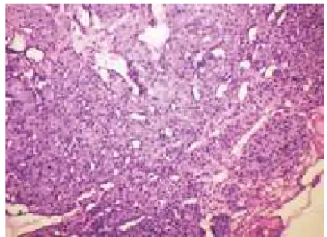 Fig. 3: Microphotograph showing Well  Encapsulated Tumor with Oncocytes  Arranged in Organoid and Trabecular 
