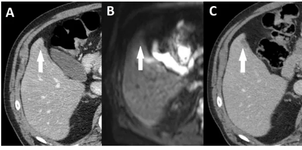Figure 2 Missed liver metastasis on CT and diffusion weighted MR. (A) Initial CT, (B) Diffusion weighted MR, (C) subsequent CT after 5 months of neoadjuvant therapy