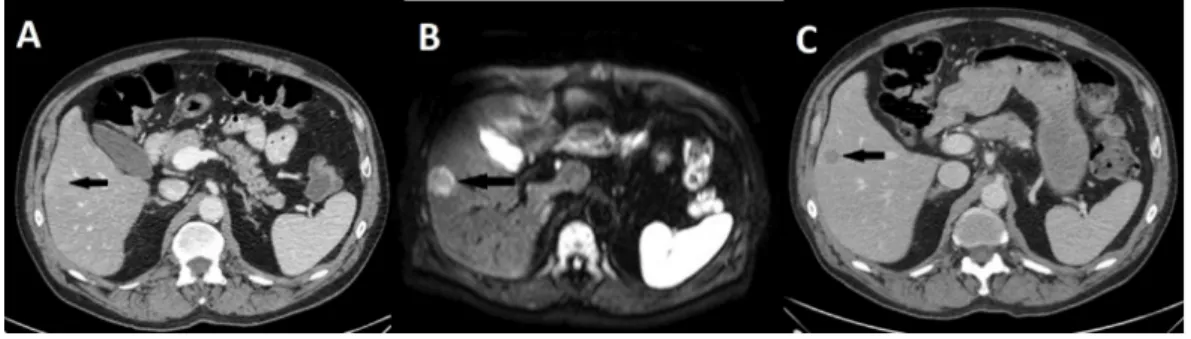 Figure 4 Missed metastasis on initial CT and diffusion weighted MR. (A) Initial CT, (B) Diffusion weighted MR, (C) CT in venous phase after 3 months of neoadjuvant therapy