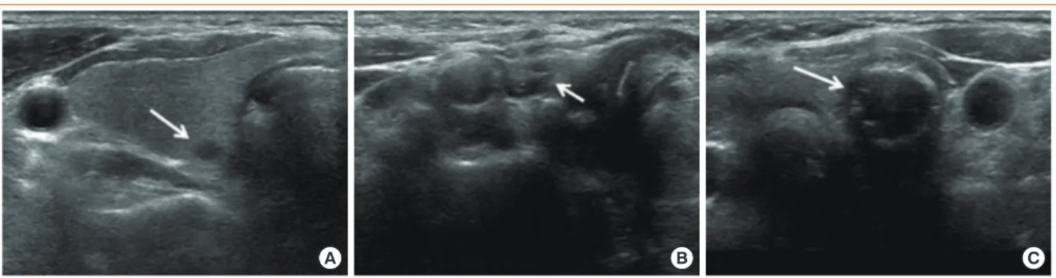 Fig. 2. An example of a potentially erroneous needle localization. (A) A bright echo (arrow) is visible in the ill-defined hypoechoic nod- nod-ule of the right thyroid lobe