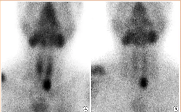 Fig. 5. To further assess the parathyroid gland, technetium-99m (Tc-99m) sestamibi parathyroid scan was carried out, showing normal  uptake pattern in both Tc-99m peretechnetate and focally increased residual uptake at the lower pole region of left thyroid
