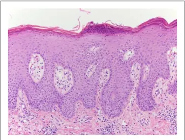 Figure 2.  Regular psoriasiform epidermal hyperplasia with  loss of the granular cell layer, parakeratosis, and Munro’s  microabscesses (hematoxylin-eosin, 200×).