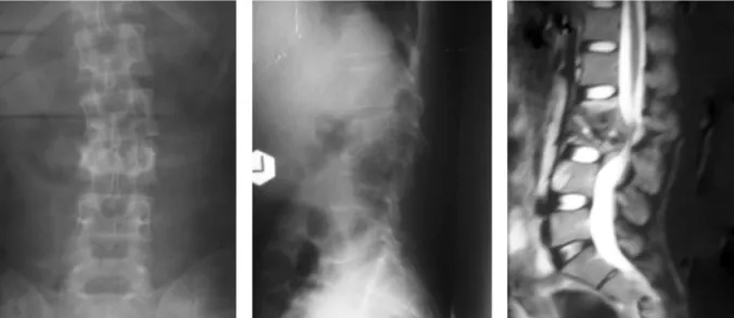 Fig. 2: Radaiographs and MRI of patient with tuberculous infection of spine L2/3 (kyphotic angle 20, TLL angle23).