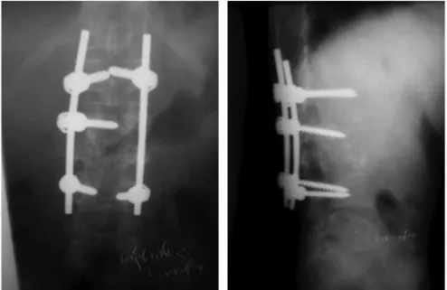 Fig. 4: Post-op radiograph showing correction at 3 months (kyphotic angle 0/TLL angle 30.
