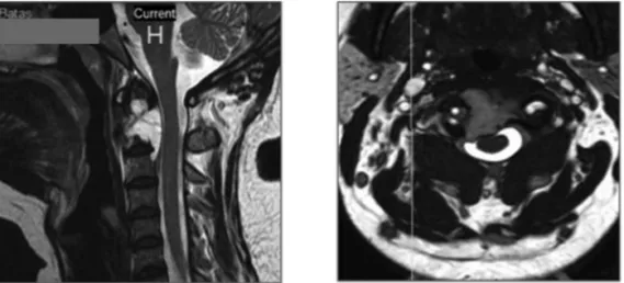 Fig. 1: Pre-operative sagittal and axial views demonstrating the extent of the tumour on the cervical MRI.