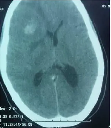 Figure 3: Right fronto- parietal brain metastasis enhanced after the injection of contrast material associated with peritumoral edema and mass effect on CT scan.