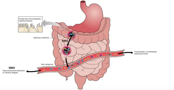 Figura 5 - Translocação da MI do cólon para o intestino delgado, causando SIBO. Através da disrupção da  barreia  endotelial  intestinal,  o  SIBO  facilita  a  entrada  de  uma  parte  da  MI  translocada  na  corrente  sanguínea (Adaptado de Sekirov et a