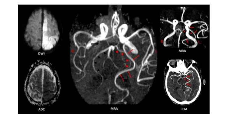 Figure 2.  Patient 2 had acute infarcts in the left ACA, MCA, and PCA territories (hyperintense DWI, low ADC)