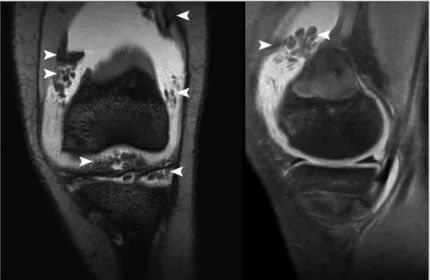 FIGURE 2. Coronal (left) and sagital (right) T2-weighted MRI view, with fat signal saturation, showing a signal suppression in the proliferative mass (arrow heads)