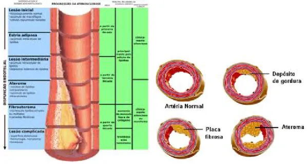 Figura 18 – Representação esquemática da formação da placa aterosclerótica. [46]